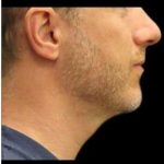 Laser Neck Lift and Submental Liposuction Before & After Patient #1304
