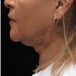Laser Neck Lift and Submental Liposuction Before & After Patient #1315
