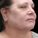 Laser Neck Lift and Submental Liposuction Before & After Patient #1328