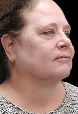 Laser Neck Lift and Submental Liposuction Before & After Patient #1328