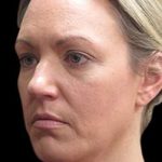Laser Neck Lift and Submental Liposuction Before & After Patient #1335