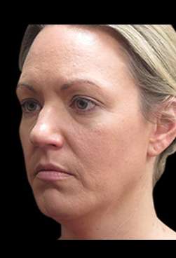 Laser Neck Lift and Submental Liposuction Before & After Patient #1335