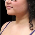 Laser Neck Lift and Submental Liposuction Before & After Patient #1346