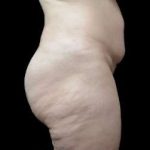 Super Wet Liposuction Before & After Patient #1353