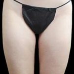 Super Wet Liposuction Before & After Patient #1372