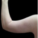 Arm Liposuction Before & After Patient #622