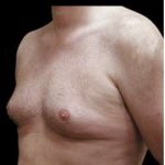 Liposuction and Gynecomastia Before & After Patient #775