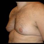 Liposuction and Gynecomastia Before & After Patient #786