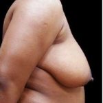 Liposuction and Breast Reduction Before & After Patient #627
