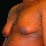 Liposuction and Gynecomastia Before & After Patient #793