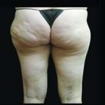 Female Liposuction Before & After Patient #805