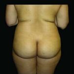 Female Liposuction Before & After Patient #813