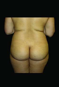 Female Liposuction Before & After Patient #813