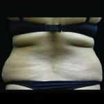 Female Liposuction Before & After Patient #818