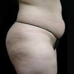 Female Liposuction Before & After Patient #825