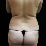 Female Liposuction Before & After Patient #834