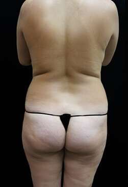 Female Liposuction Before & After Patient #834