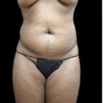 Female Liposuction Before & After Patient #852