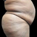 Female Liposuction Before & After Patient #863