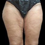 Female Liposuction Before & After Patient #868