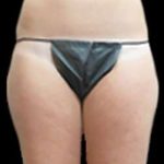 Female Liposuction Before & After Patient #877