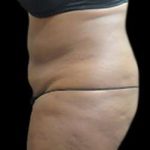 Female Liposuction Before & After Patient #887
