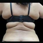 Female Liposuction Before & After Patient #899