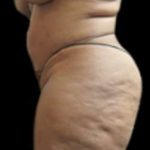 Female Liposuction Before & After Patient #908