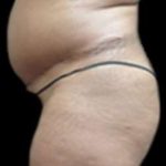 Female Liposuction Before & After Patient #915