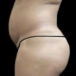 Female Liposuction Before & After Patient #923