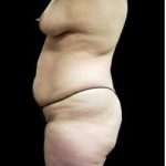 Female Liposuction Before & After Patient #930