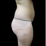 Female Liposuction Before & After Patient #939