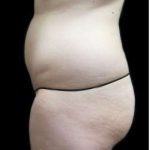 Female Liposuction Before & After Patient #948