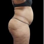 Female Liposuction Before & After Patient #960