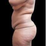 Female Liposuction Before & After Patient #986