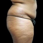 Female Liposuction Before & After Patient #995