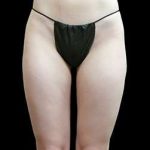Female Liposuction Before & After Patient #1000