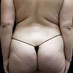 Female Liposuction Before & After Patient #1005