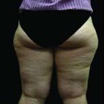Female Liposuction Before & After Patient #1019
