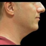 Male Liposuction Before & After Patient #1039