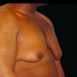 Male Liposuction Before & After Patient #1071