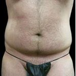 Male Liposuction Before & After Patient #1080