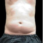 Male Liposuction Before & After Patient #1089