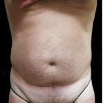 Male Liposuction Before & After Patient #1099