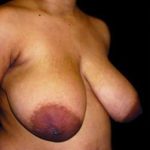 Liposuction and Breast Reduction Before & After Patient #661