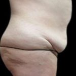 Liposuction and Mommy Makeover Before & After Patient #1112
