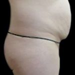 Liposuction and Mommy Makeover Before & After Patient #1133