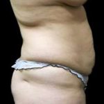 Liposuction and Mommy Makeover Before & After Patient #1150