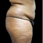 Liposuction and Mommy Makeover Before & After Patient #1157