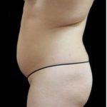 Liposuction and Mommy Makeover Before & After Patient #1166